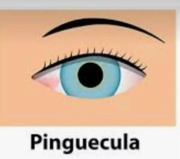 Pinguecula